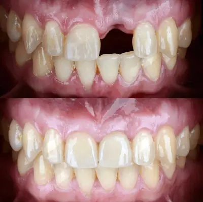Dental implant patient case at Vivan Dental