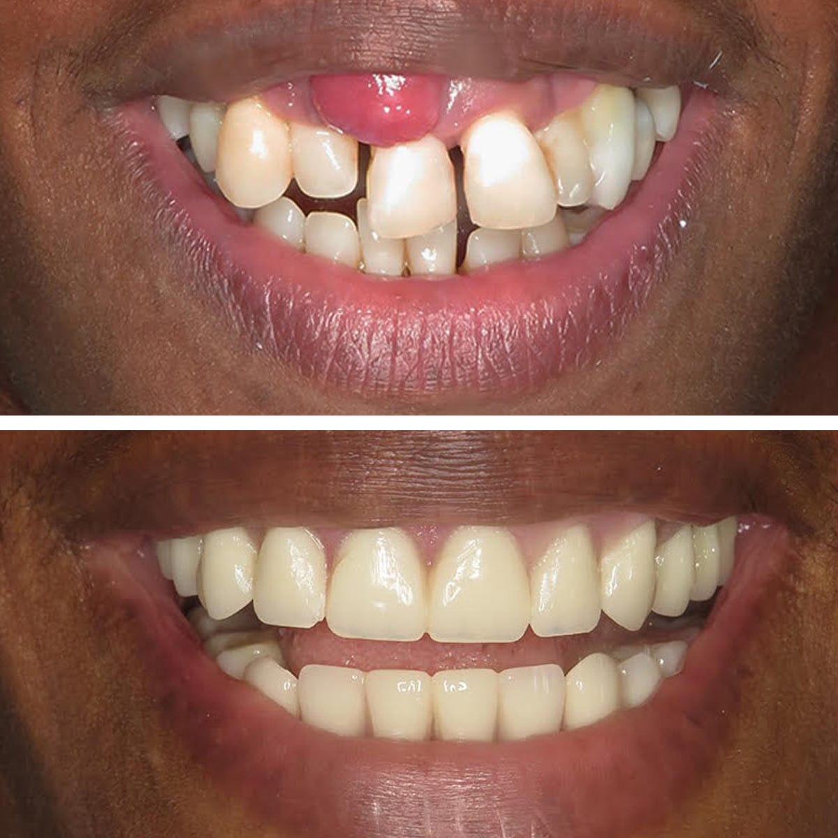 Dental implant treatment case at Vivan Dental