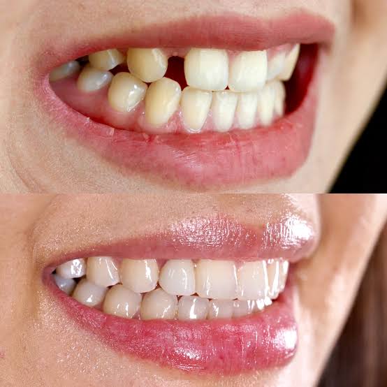 Dental implant before and after case at Vivan Dental